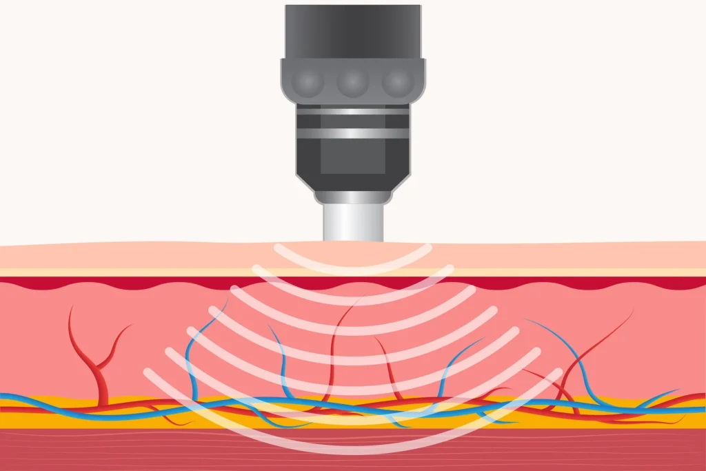 A Shockwave Therapy handpiece in use over the heel during a session in Dumont