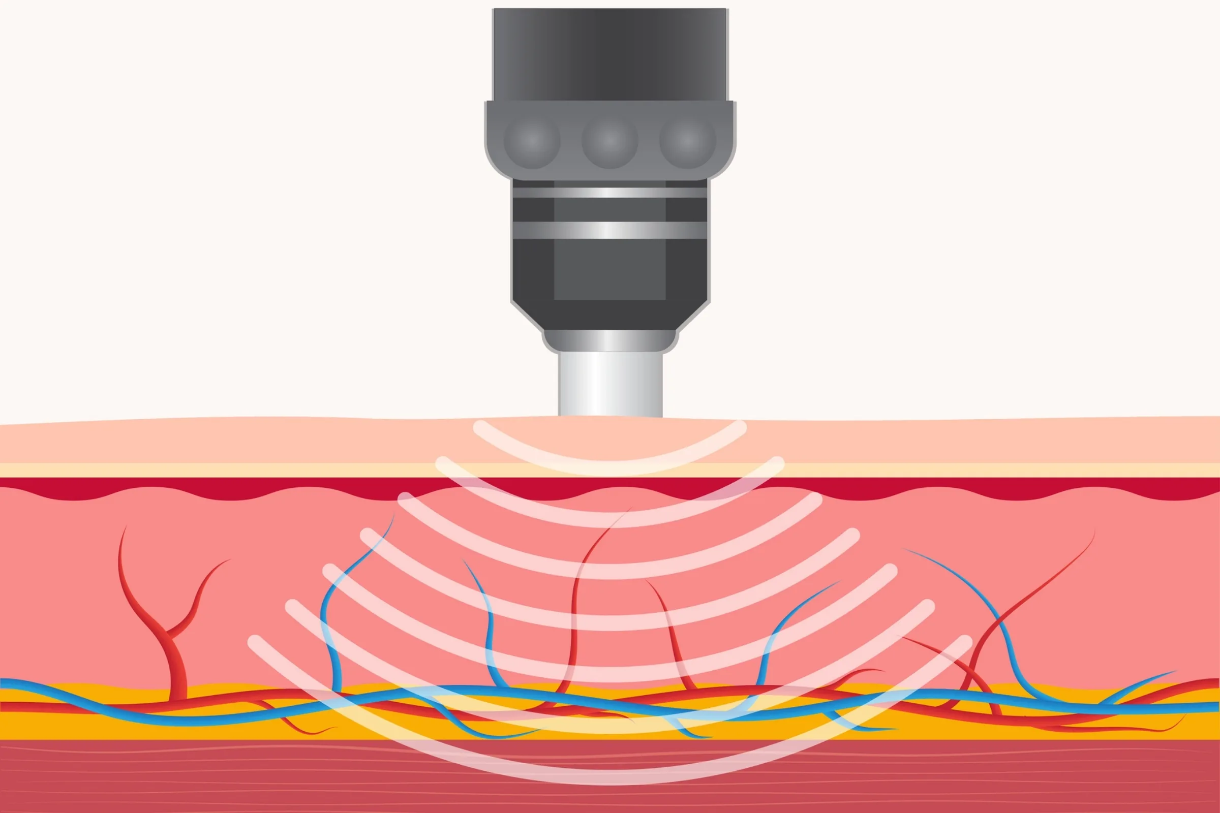 A shockwave therapy handpiece in use over the heel during a session in Dumont
